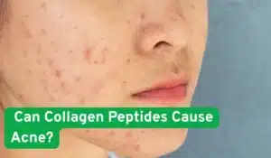 Can Collagen Peptides Cause Acne?