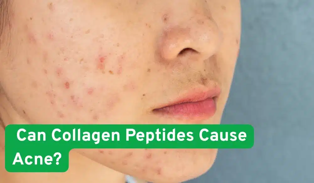 Can Collagen Peptides Cause Acne?